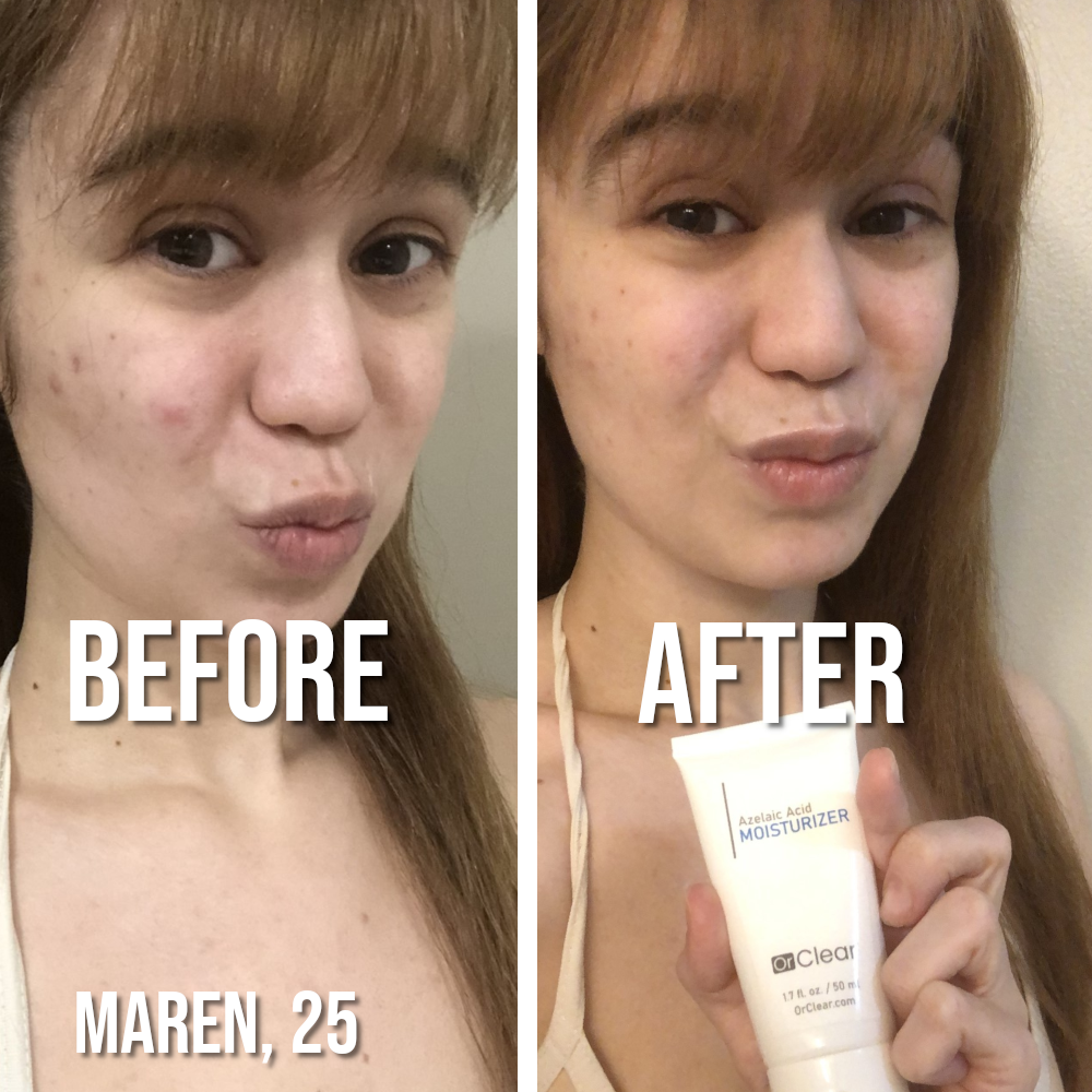 Before and after - real customer results with Or Clear