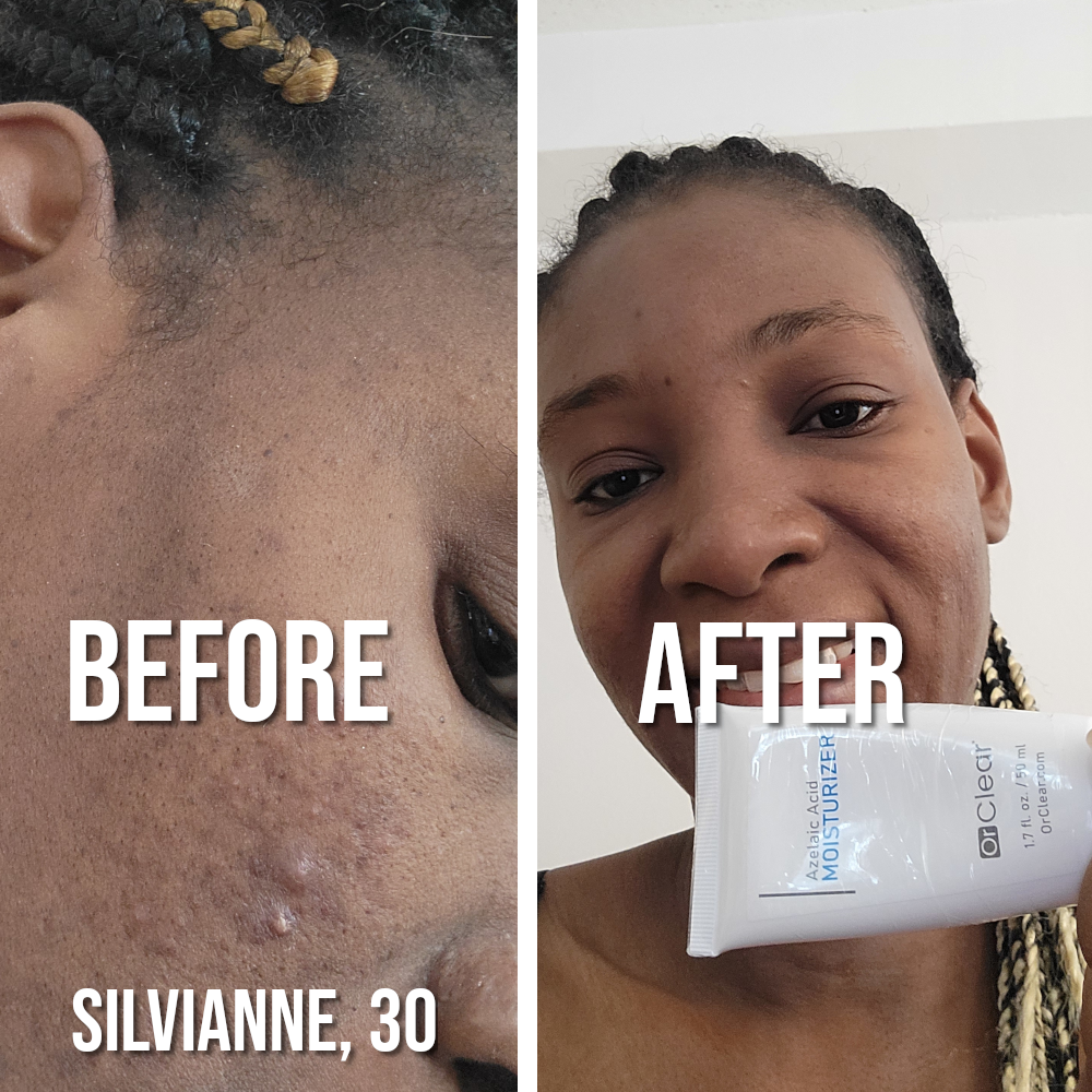 Before and after results with Or Clear